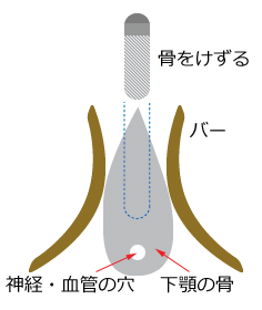 骨がうすい場合のインプラント治療