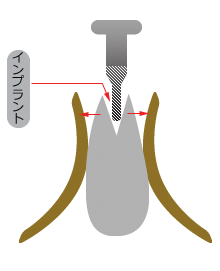 骨がうすい場合のインプラント治療