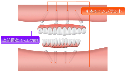 インプラントの構造