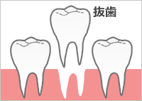 抜歯する 抜歯する