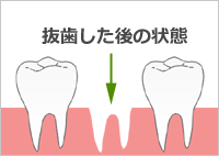 抜歯後の状態 抜歯後の状態